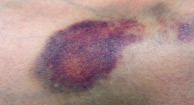 194x105_Bruises_0
